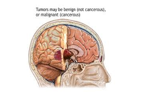 Tumor Surgery